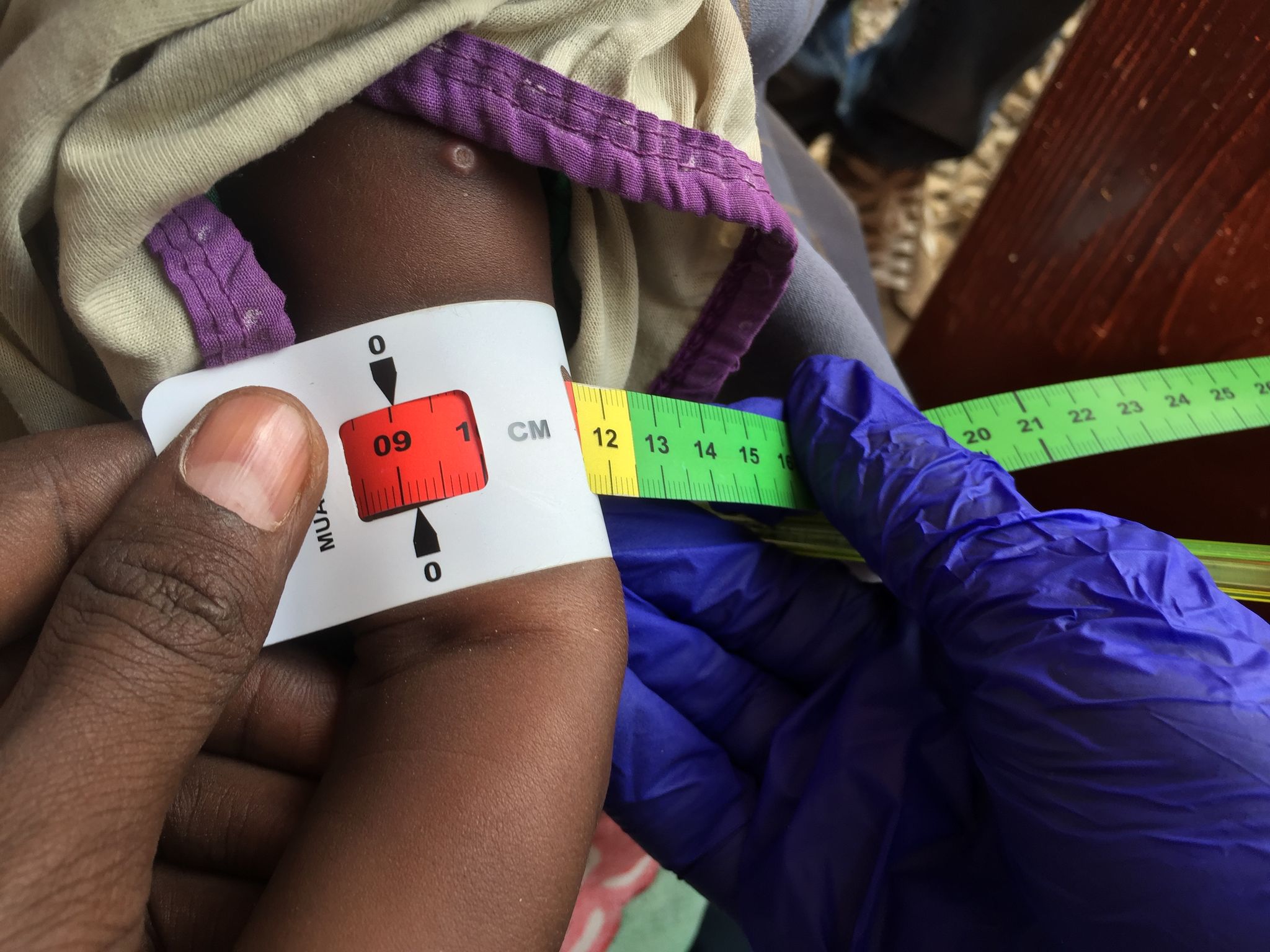 Hunger in Somalia